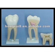 ISO Amplified Molar Model, Dental Molar Teeth Model HR/B10005-1